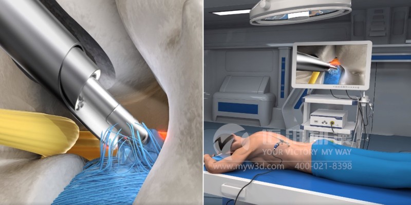 醫(yī)學(xué)三維動(dòng)畫制作效果展示-上海三維動(dòng)畫制作(圖2) 醫(yī)學(xué)三維動(dòng)畫制作效果展示-上海三維動(dòng)畫制作(圖2)